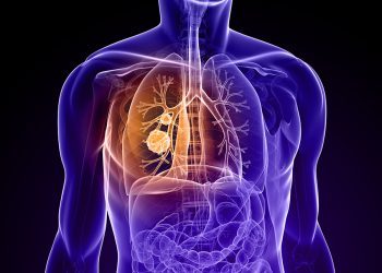 Diagram of a torso showing site of cancer in the lung